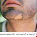  پکیج گیاهی رفع ریزش سکه ای مو(رفع آلوپیسی باربا)این بیماری شایع که بنام آلو پیسی یا باربا نام دارد و یک بیماری خود ایمینی بوده  و براحتی با یک داروی خوب وکاربردی درمان میشود این محصول کاملا گیاهی و بدون ضرر رفع قطعی ریزش های سکه ای ریش وسبیل ومو در دوره ۳ماهه که شما در ماه اول اثر تاثیرگذاری رامیبینید و روش استفاده بسیار آسان است و ضمانت صدرصد داردتلفن تماس ؛۰۹۱۳۲۵۴۰۹۱۲ و ۰۹۳۸۵۲۶۴۵۰۹#ریش_سبیل#آلوپیسی_باربا#ریزش_،سکه_ای#درمان_ریزش_مو#درمان_موخاره#درمان_شوره سر#نرمی_ولطافت_موها#پرپشت_کننده_مو#ضدسفیدی#مو#رفع_ریزش_سکه_ای#اکسیراعظم#طب_سنتی#درمان_خانگی_ریزش_سکه_ای#درمان_ریزش_سکه_ای
