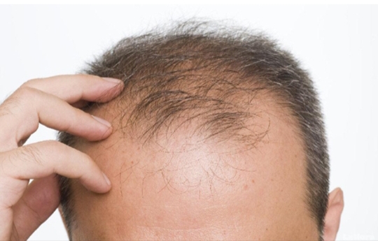 ۹دلیل اصلی وشایع ریزش مو