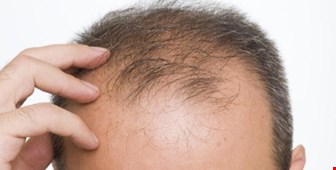۹دلیل اصلی وشایع ریزش مو